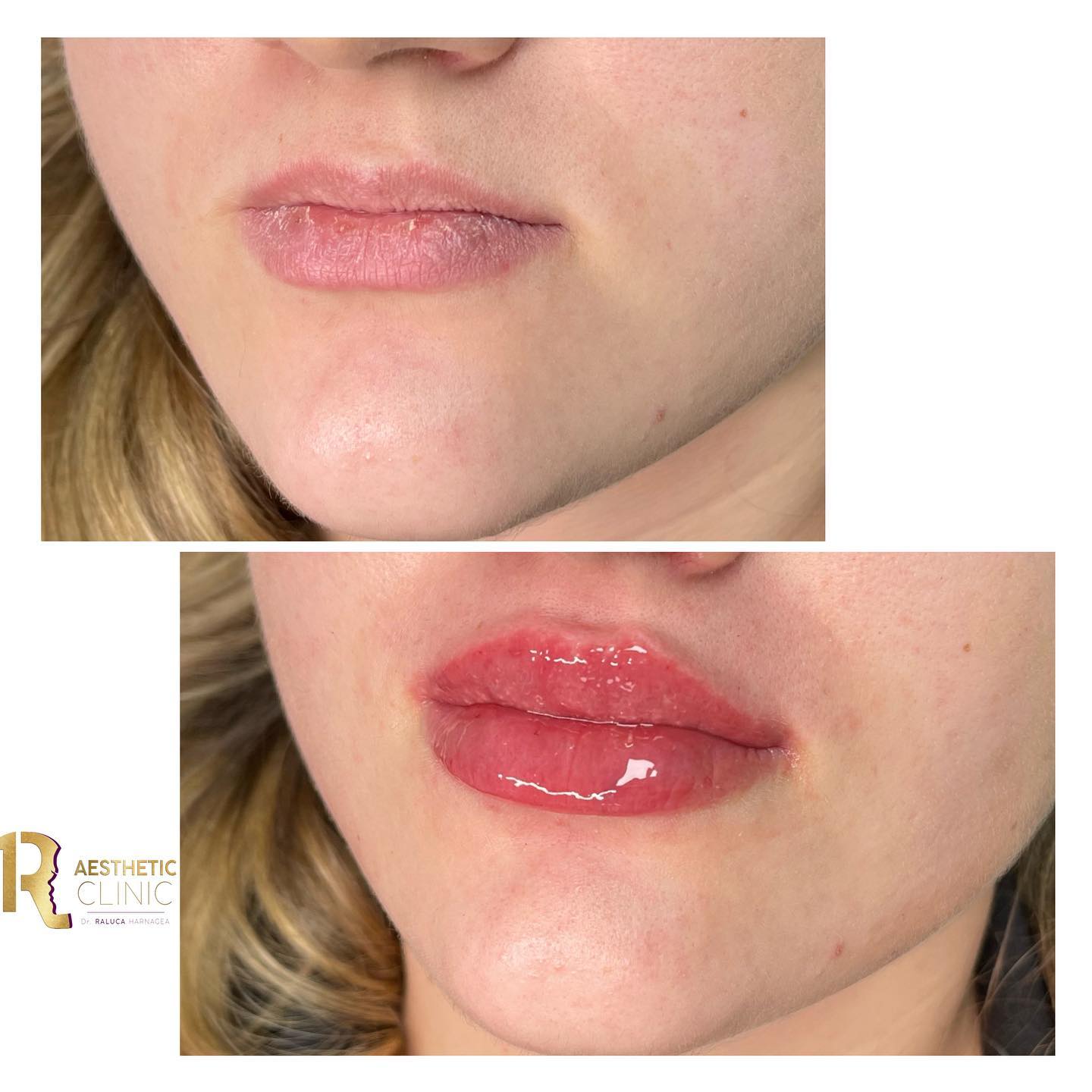 Cel mai bun acid hialuronic pentru buze Cel mai bun acid hialuronic pentru buze