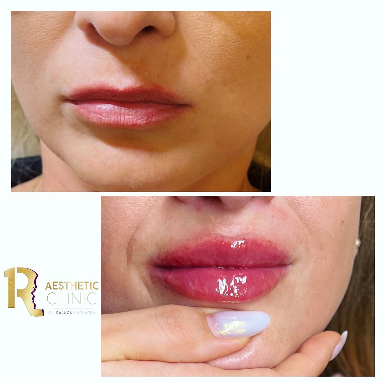 Cel mai bun acid hialuronic pentru buze Cel mai bun acid hialuronic pentru buze