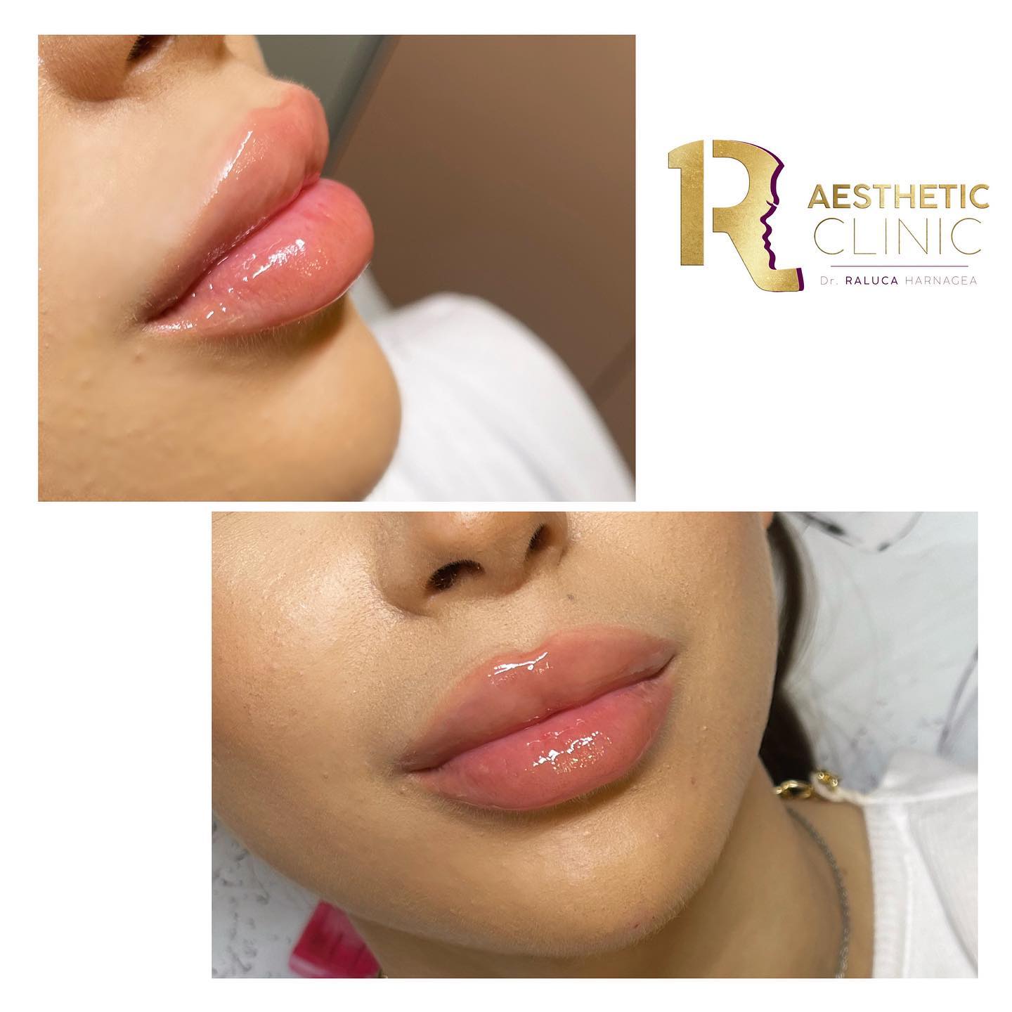 Cel mai bun acid hialuronic pentru buze Cel mai bun acid hialuronic pentru buze