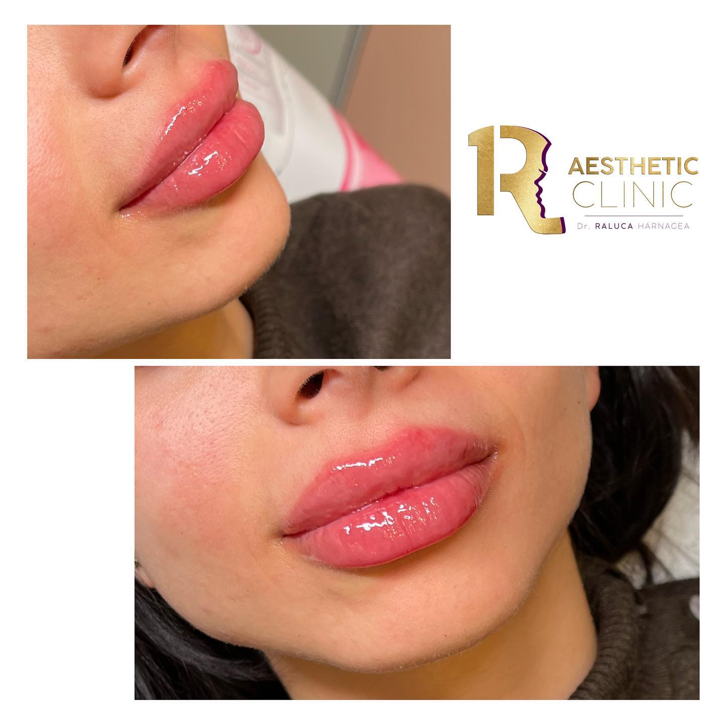 Cel mai bun acid hialuronic pentru buze Cel mai bun acid hialuronic pentru buze