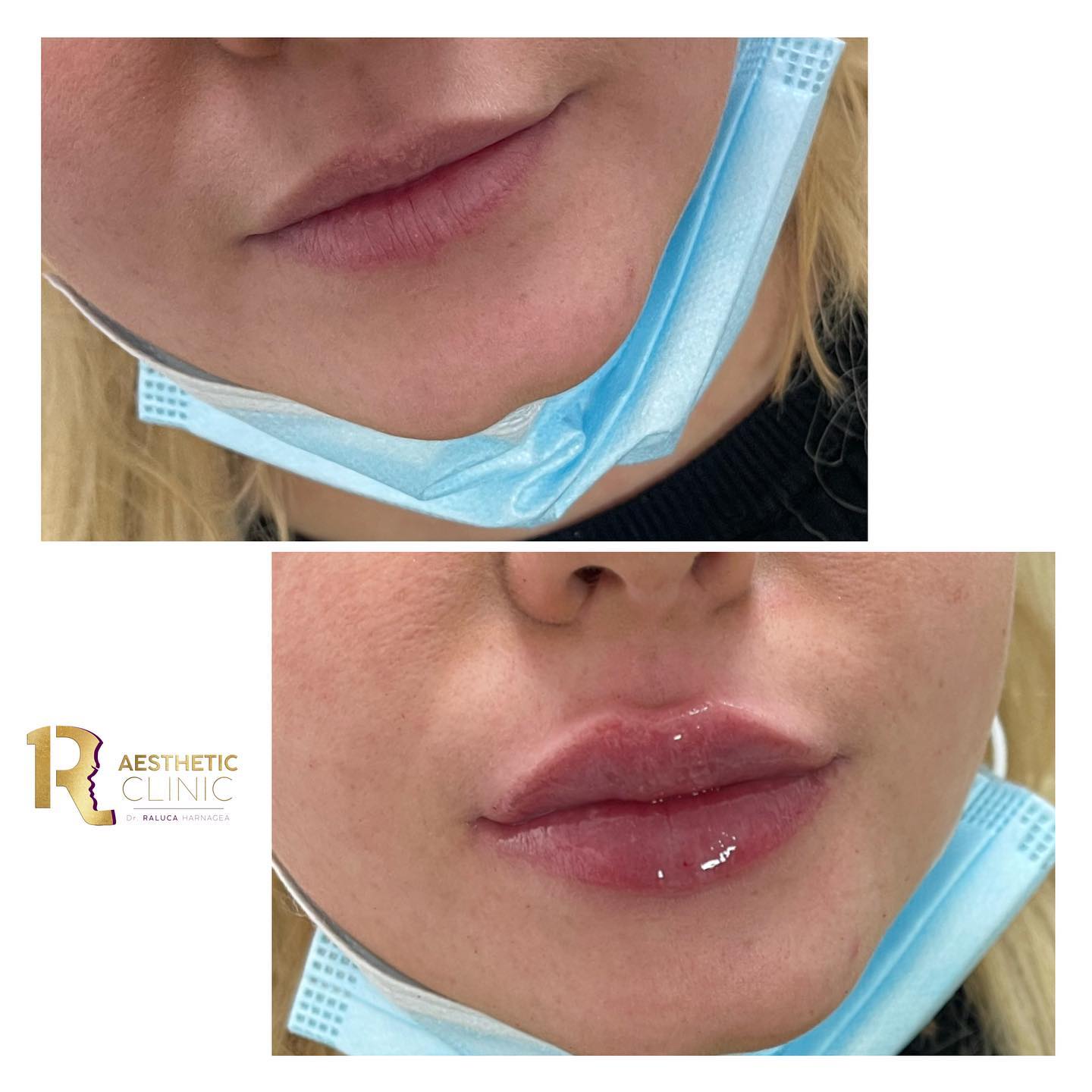 Cel mai bun acid hialuronic pentru buze Cel mai bun acid hialuronic pentru buze