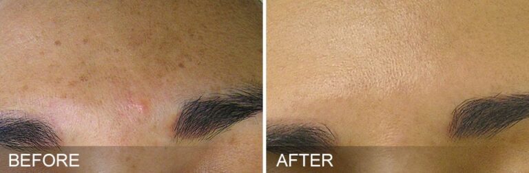 Hydrafacial București – curățare facială profundă și hidratare intensă Hydrafacial București – curățare facială profundă și hidratare intensă