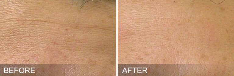 Hydrafacial București – curățare facială profundă și hidratare intensă Hydrafacial București – curățare facială profundă și hidratare intensă