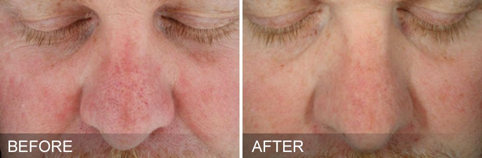 Hydrafacial Hydrafacial