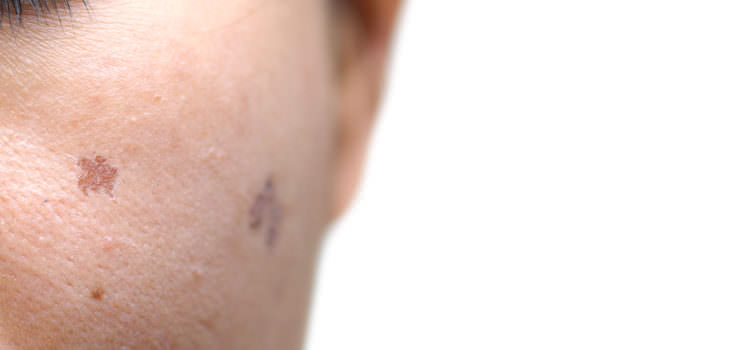 petele maronii pe piele