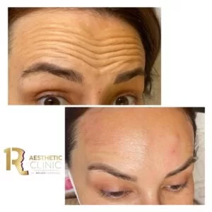 După injectarea cu toxină botulinică: ce trebuie să știi despre &icirc;ngrijire și riscuri