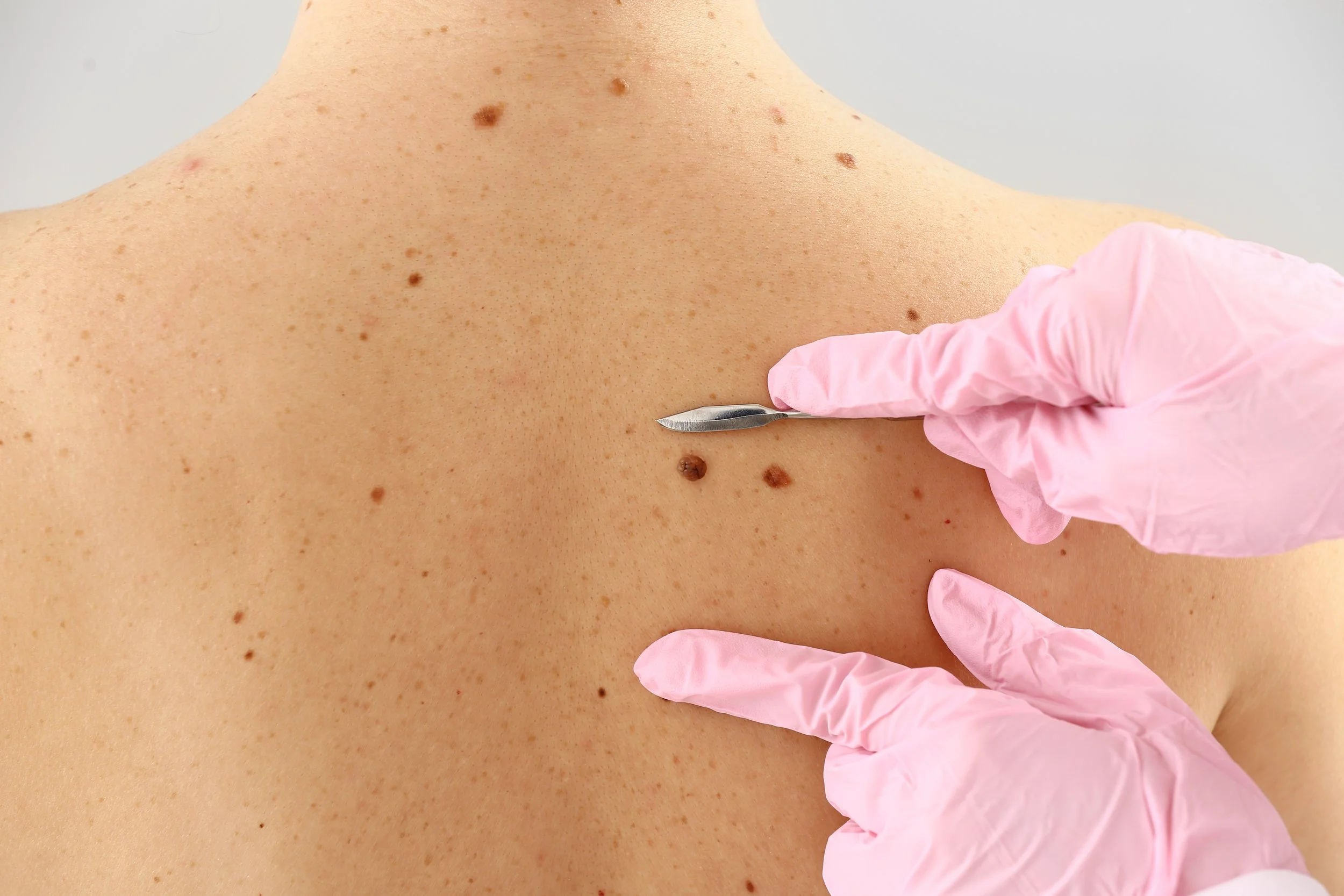 Interventii Chirurgicale Dermatologice