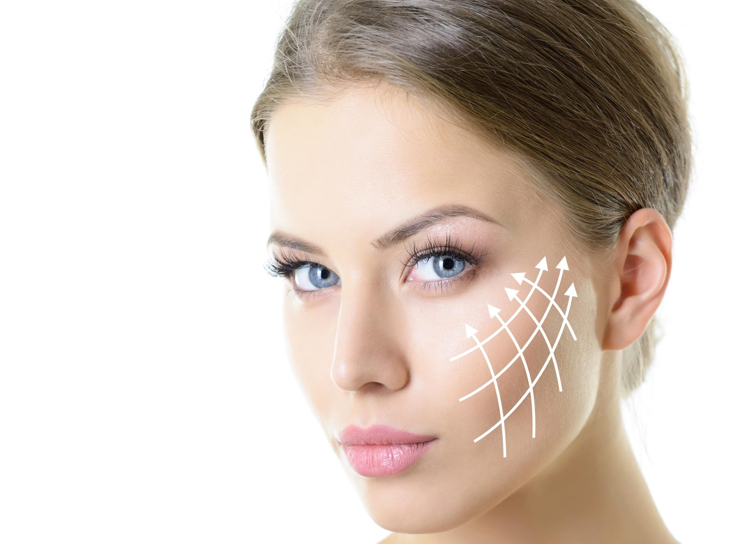 Radiesse® Radiesse®