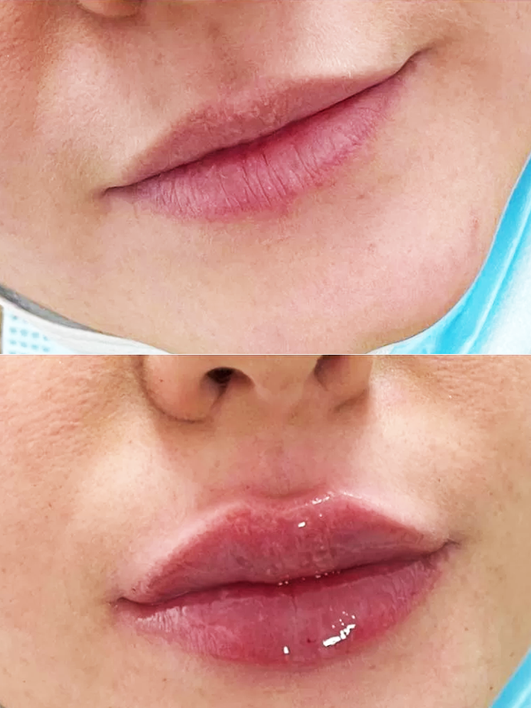 Mărirea buzelor cu acid hialuronic Mărirea buzelor cu acid hialuronic