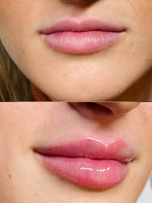 Mărirea buzelor cu acid hialuronic Mărirea buzelor cu acid hialuronic