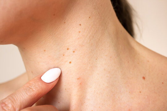 Îndepărtarea papiloamelor acasă - Riscuri și Alternative Îndepărtarea papiloamelor acasă - Riscuri și Alternative