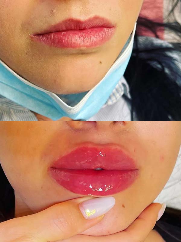 Mărirea buzelor cu acid hialuronic Mărirea buzelor cu acid hialuronic