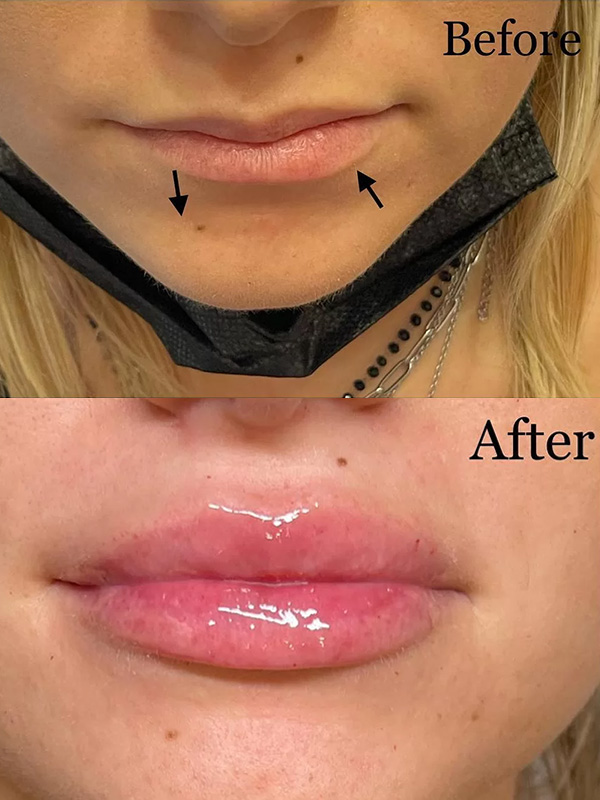 Mărirea buzelor cu acid hialuronic Mărirea buzelor cu acid hialuronic