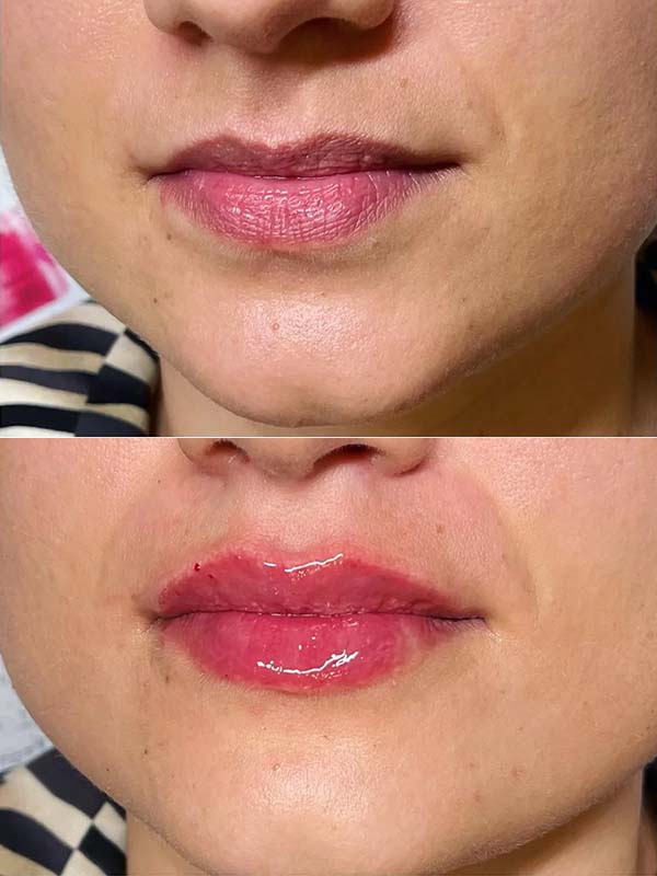 Mărirea buzelor cu acid hialuronic Mărirea buzelor cu acid hialuronic