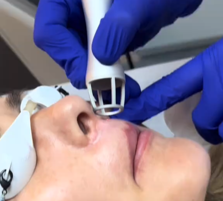 &Icirc;ndepărtarea Alunițelor cu Laser sau Chirurgical &icirc;n București