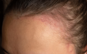 Psoriazis pe scalp: simptome, cauze, diagnostic și tratament Psoriazis pe scalp: simptome, cauze, diagnostic și tratament