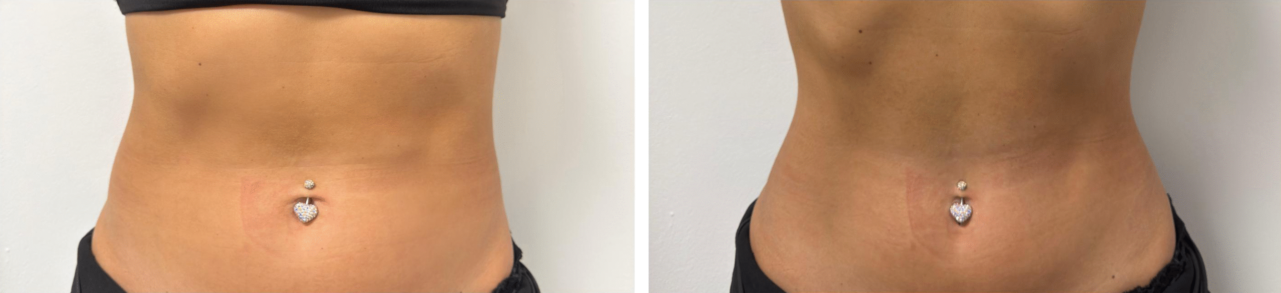 NuEra&reg; Tight &icirc;n București &ndash; tratament pentru fermitate, celulită și remodelare corporală