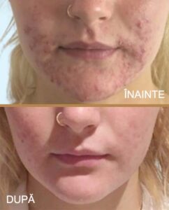 Dermapen | Microneedling pentru cicatrici, pori și rejuvenare