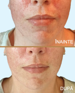 Dermapen | Microneedling pentru cicatrici, pori și rejuvenare