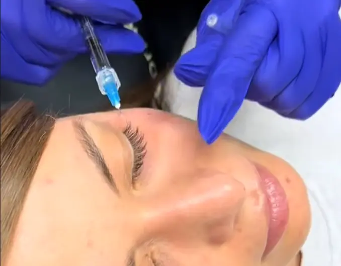 Tratament cu polinucleotide &icirc;n București