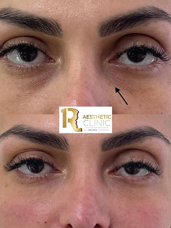 Injectari cu Acid Hialuronic &icirc;n București
