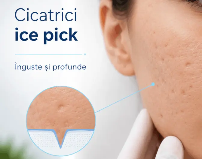 Cicatrici post-acnee: tipuri și opțiuni de tratament Cicatrici post-acnee: tipuri și opțiuni de tratament